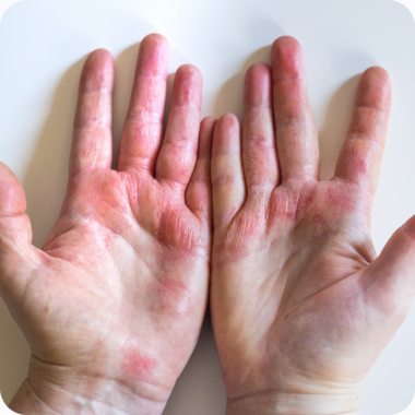 eczema on the hands