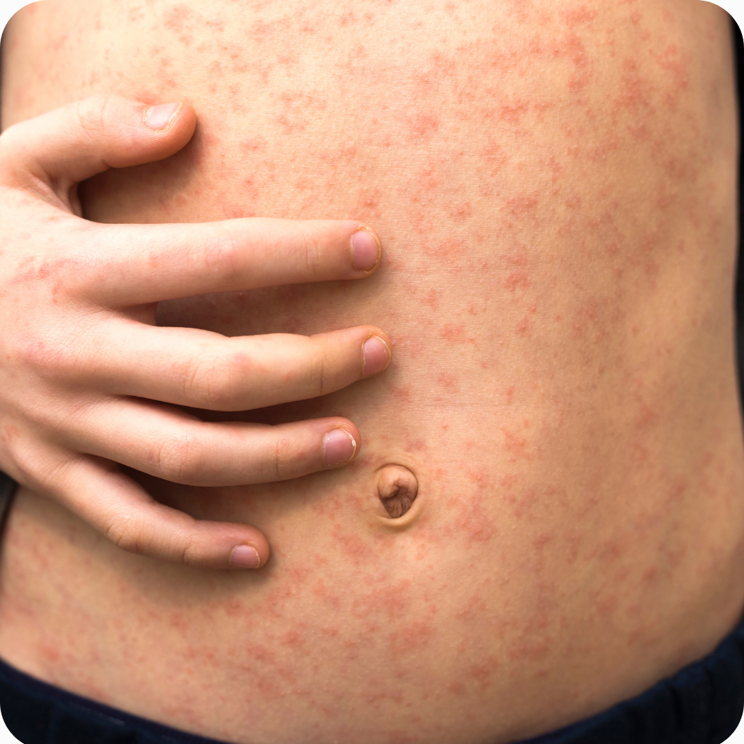 measles symptoms photos