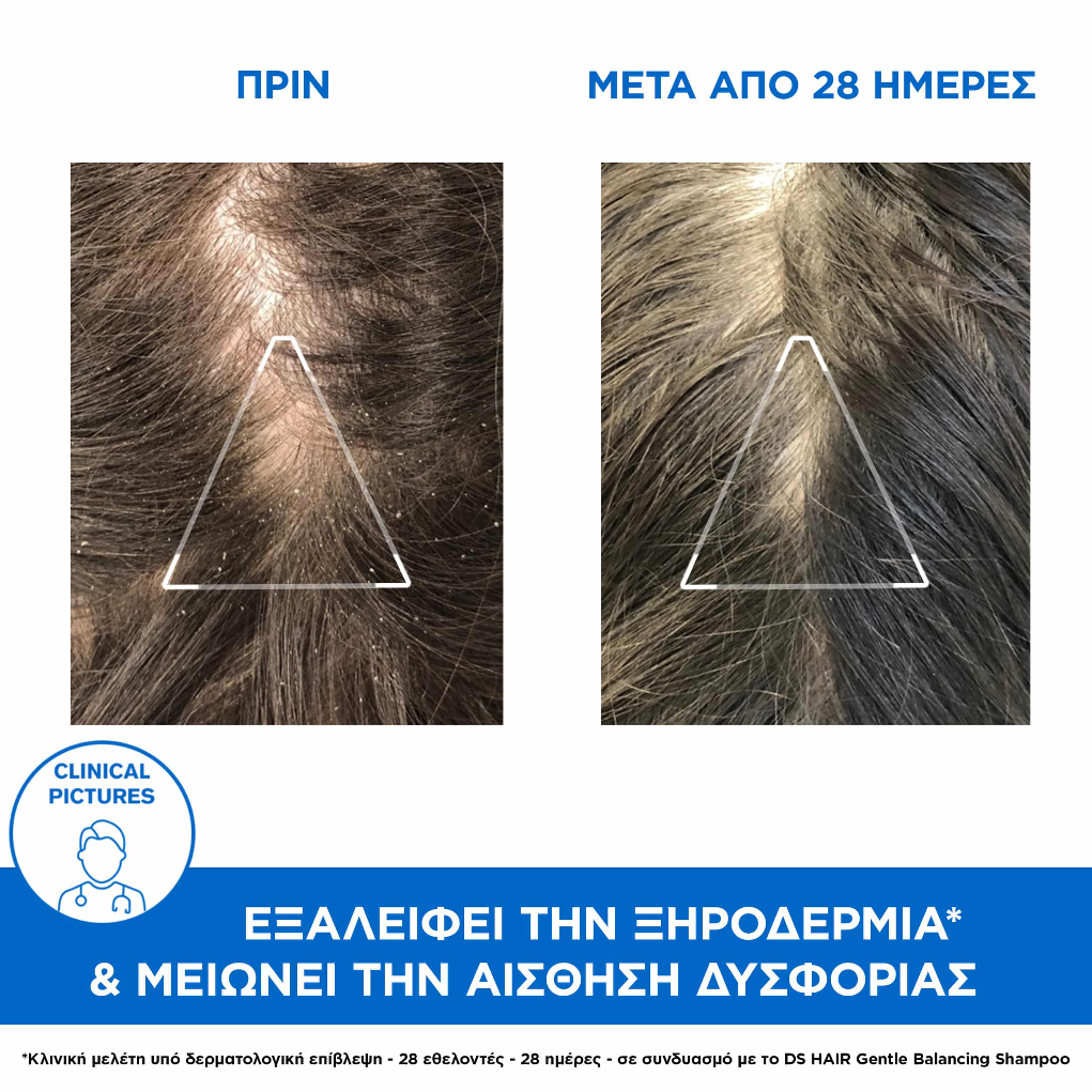 Uriage DS Hair Anti-Dandruff Treatment Shampoo, Αντιπυτιριδικό Σαμπουάν 200ml