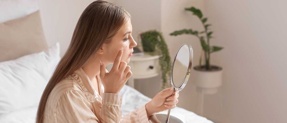 Décoder l'acné : comprendre les causes, les symptômes et le traitementphoto