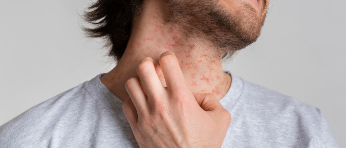 Eczema: What is it and how is it treated? photo