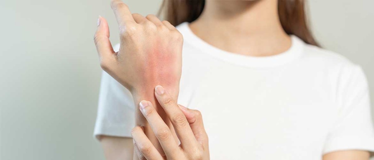 التهاب الجلد التأتبي (الأكزيما): الأعراض والأسباب الصورة