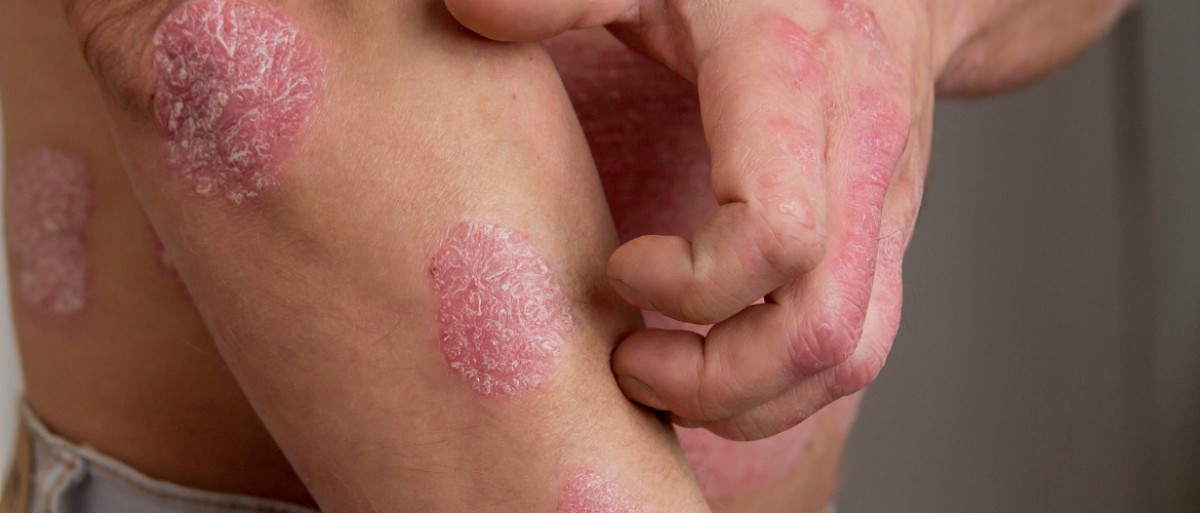 Psoriasis: Mythen und Wahrheiten, die Sie kennen sollten Foto