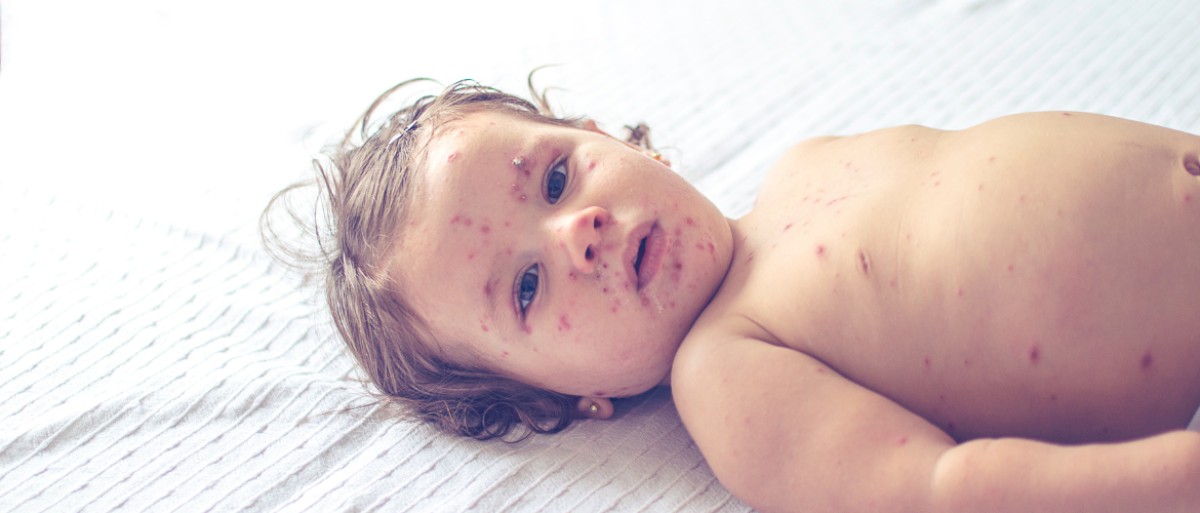 Morbillo: sintomi e foto del vaccino contro il morbillo