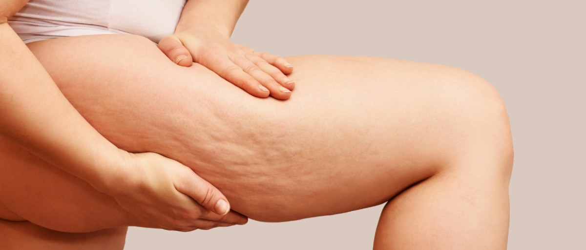 Cellulite: cos'è e come trattarla subito foto!